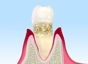 歯周病・予防治療