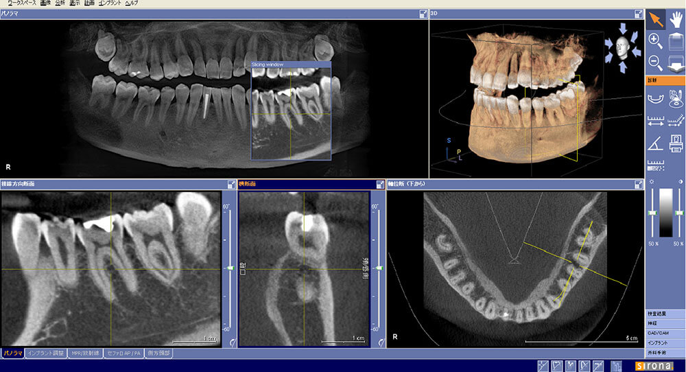 歯科用CTを導入