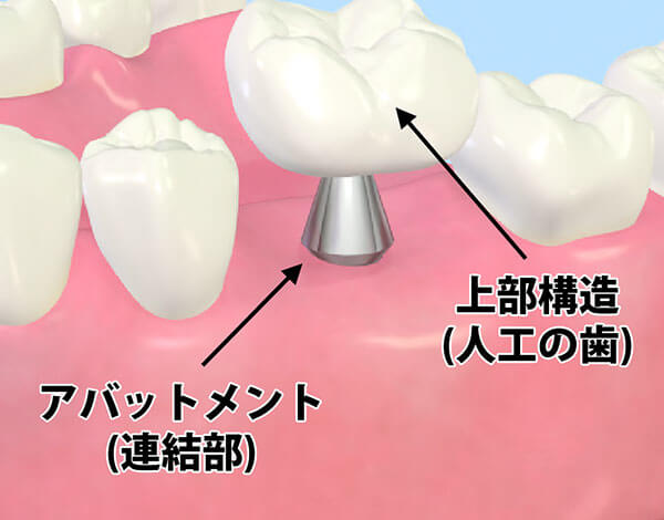 人工歯の作製と装着