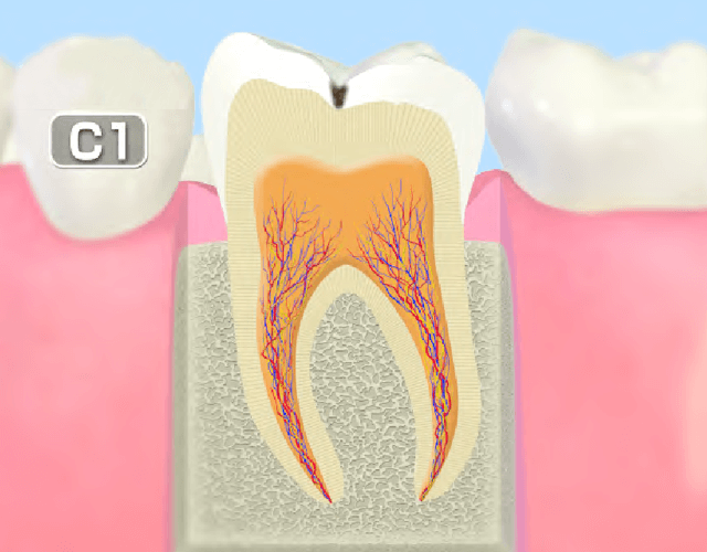 C1～初期のむし歯～