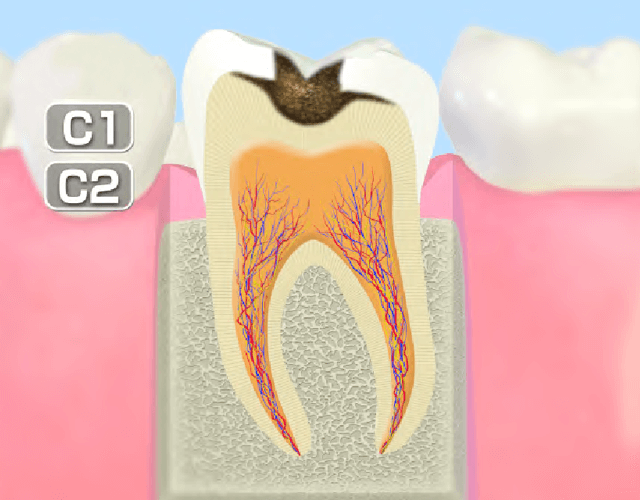 C2～進行したむし歯～