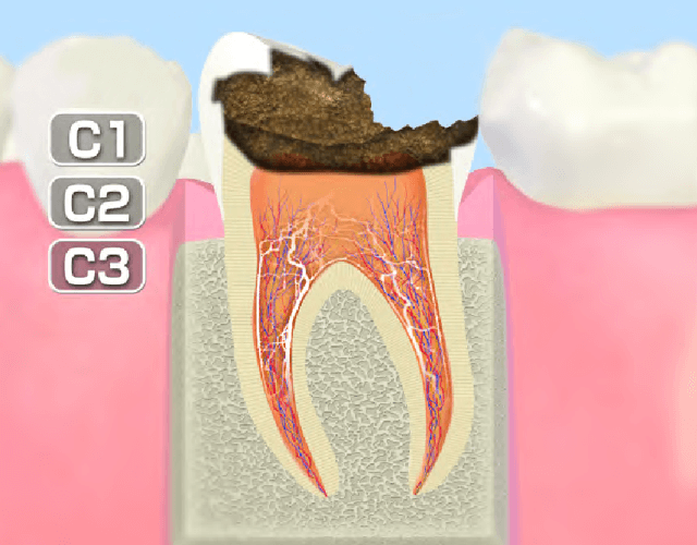 C3～歯髄まで進行したむし歯～