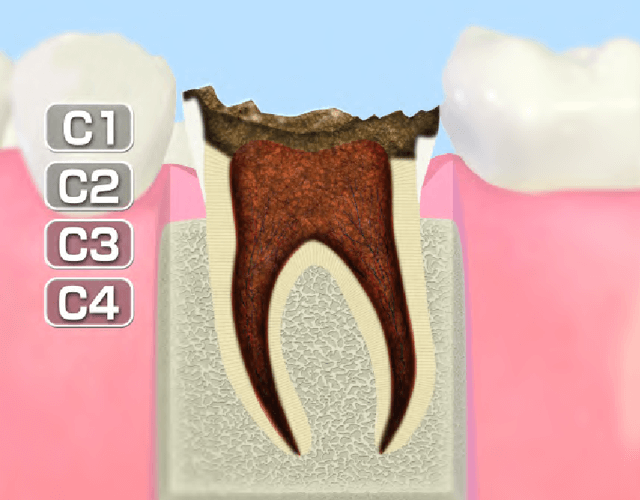 C4～歯質が失われた歯～