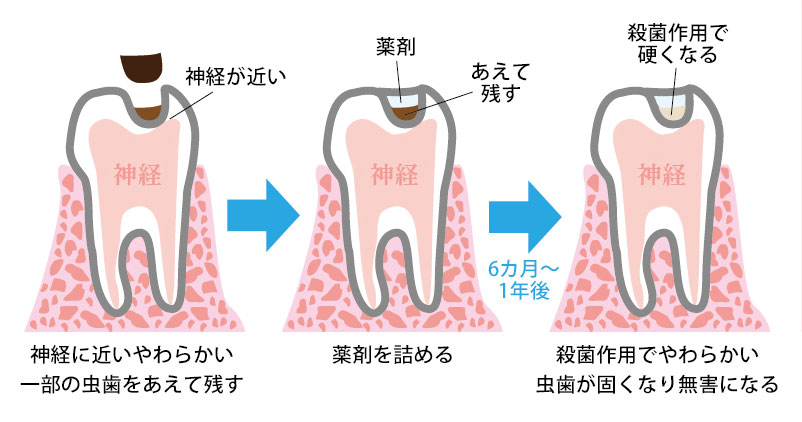 むし歯菌を削ることなくミネラルで殺菌する