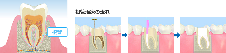 根管治療の流れ