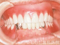 仮義歯