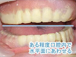 入れ歯の修整2