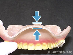 レジン床の入れ歯の厚み