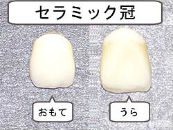 天然歯の色に近い素材のかぶせ物