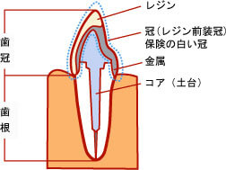 かぶせ物を装着するまでの流れ