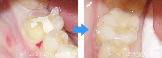 生活歯(神経のある歯)へのハイブリッドセラミック冠