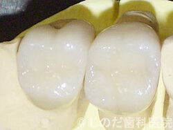 奥歯、大臼歯のハイブリッドセラミック冠2
