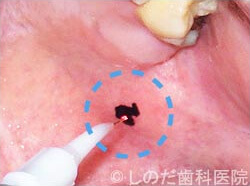 口内炎の治療