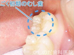 初期のむし歯治療 治療前