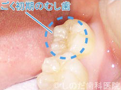 レーザー治療 治療前