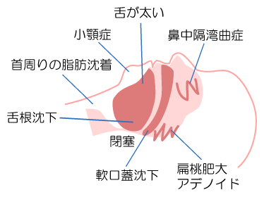 睡眠時無呼吸症候群　イラスト