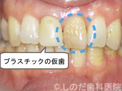 神経のない歯のホワイトニング