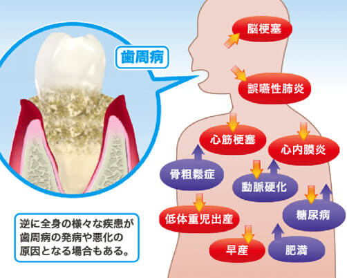 歯周病と全身疾患との関係